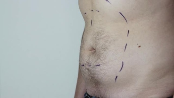 一名肥胖的男性患者在整形手术前要去除脂肪，吸脂。复制文本空间