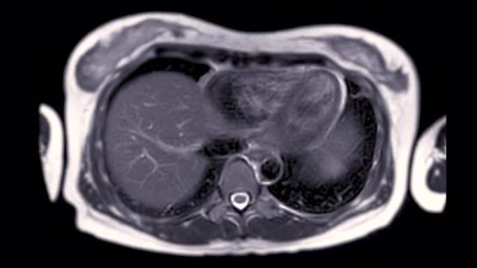 MRI上腹部用于诊断肝肿瘤或肝细胞癌 (HCC)。
