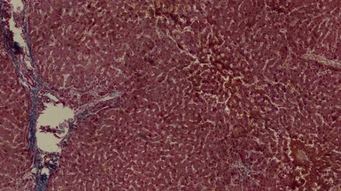 显微镜下有肿块和肿胀的人肝硬化的显微照片