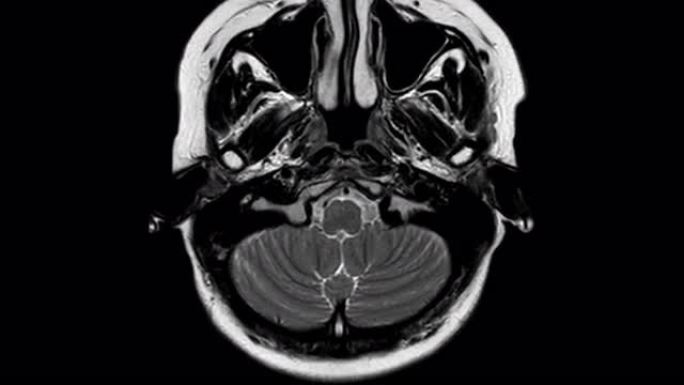 脑部核磁共振成像。