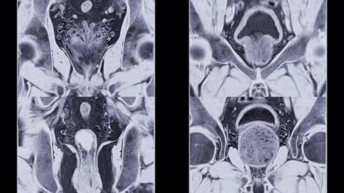 老年男性前列腺MRI诊断前列腺癌细胞。