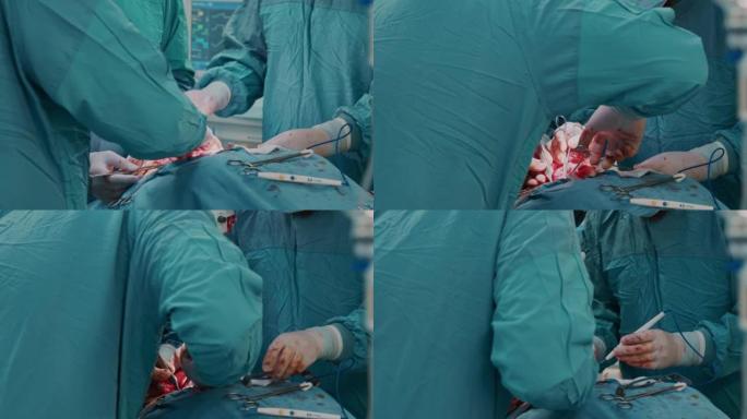 医疗小组用医用剪刀和镊子对淋巴结进行手术