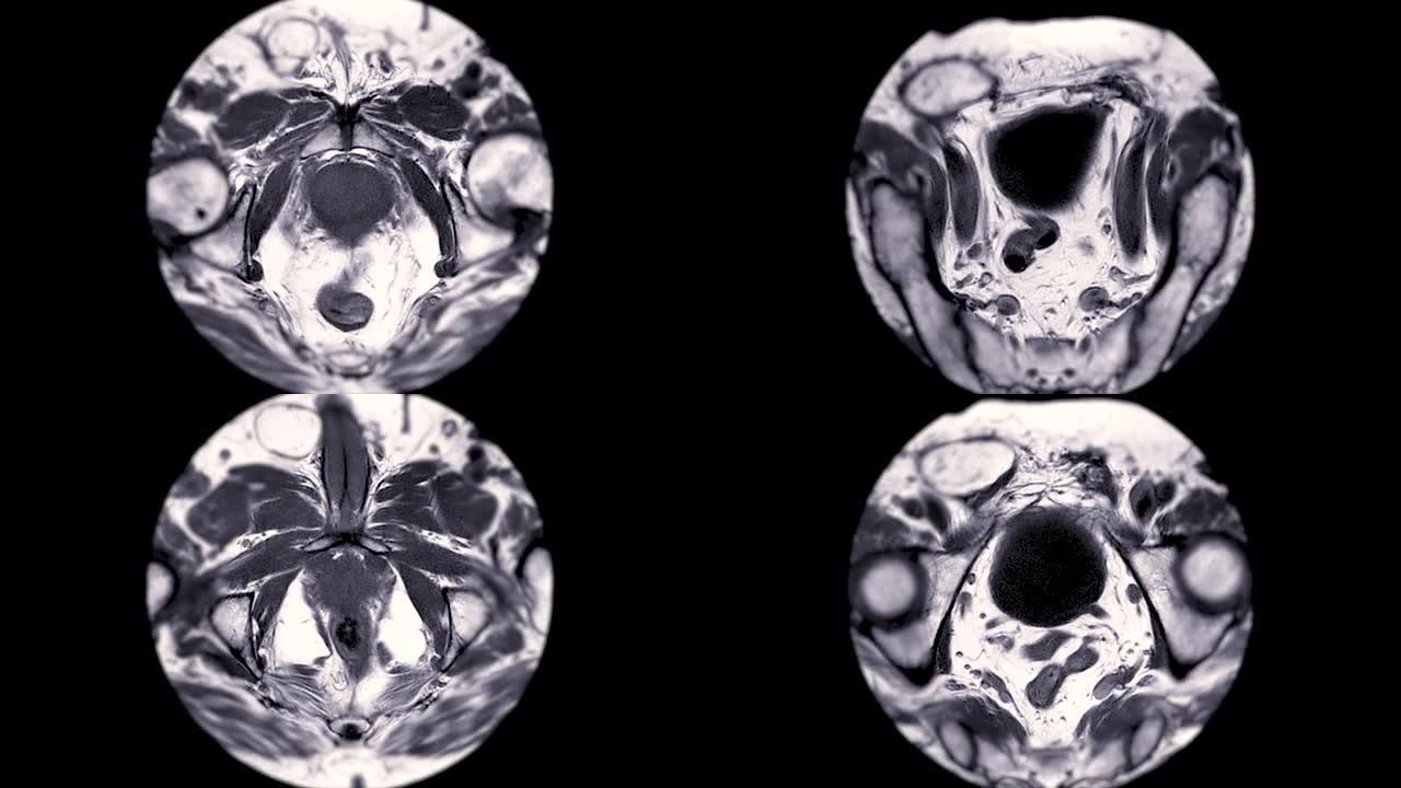 老年男性的MRI前列腺。
