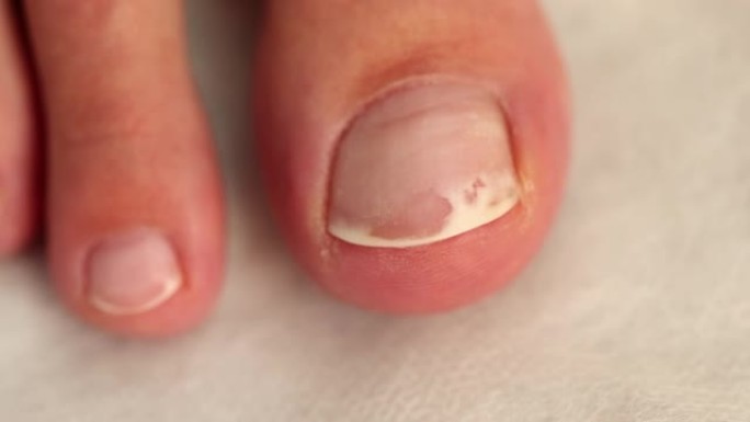 指甲真菌和白色受伤指甲的脚特写