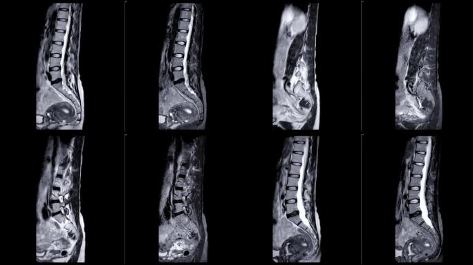 MRI l-s脊柱