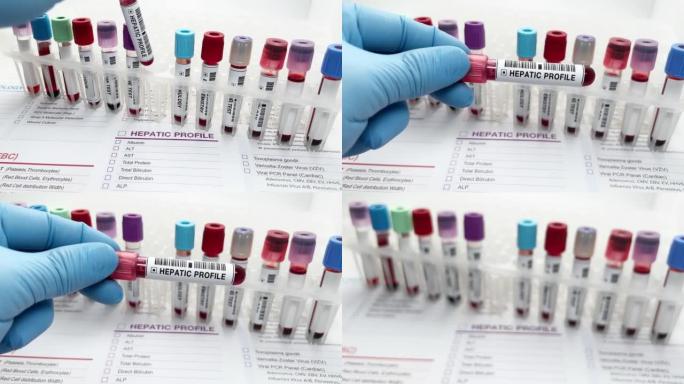 在实验室中使用血液样本进行肝病测试的医生