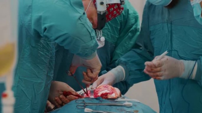 外科医生切割并切除淋巴结上的癌性肿瘤和附近组织