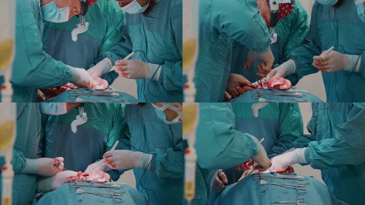 外科医生切割并切除淋巴结上的癌性肿瘤和附近组织