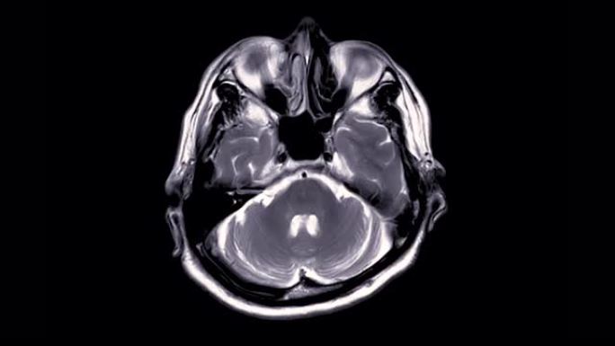 脑部核磁共振成像。