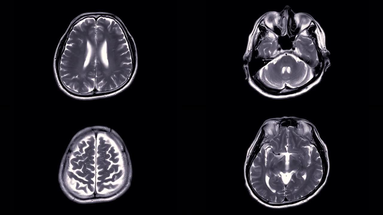 脑部核磁共振成像。