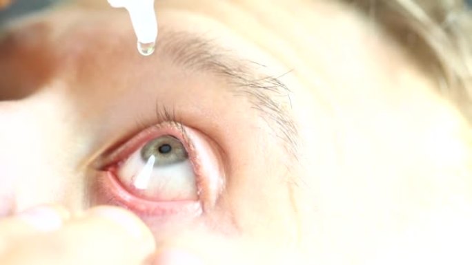 人在隐形眼镜后滴眼药水并滋润眼角膜