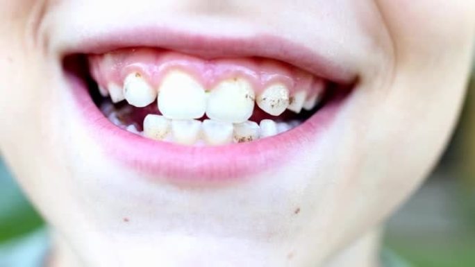 张开牙齿上有牙菌斑或牙结石的男孩的嘴。口腔卫生概念。