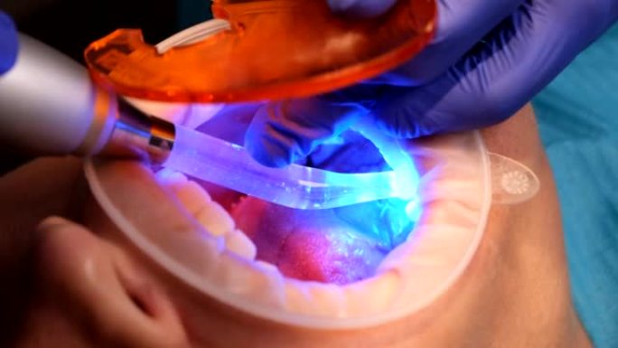 牙医做牙齿美白程序或安装陶瓷贴面