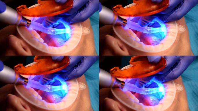 牙医做牙齿美白程序或安装陶瓷贴面