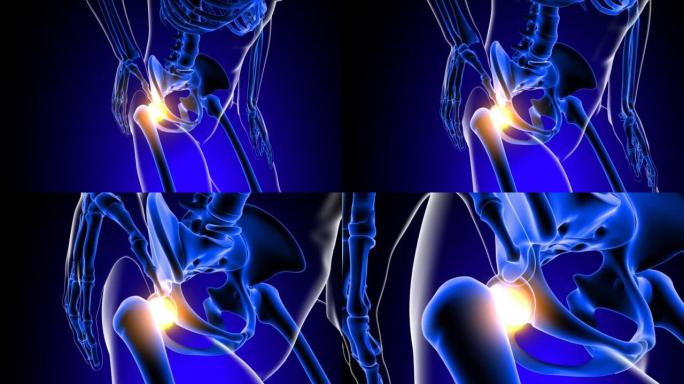髋关节疼痛解剖医学概念3D