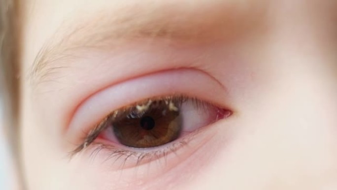 患有结膜炎的孩子的眼睛，结膜发炎，特写。