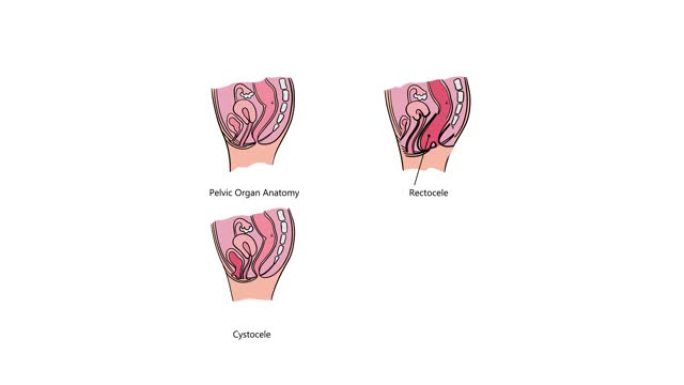 盆腔器官脱垂各种视频教育动画