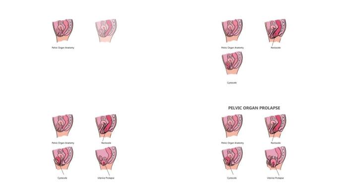 盆腔器官脱垂各种视频教育动画
