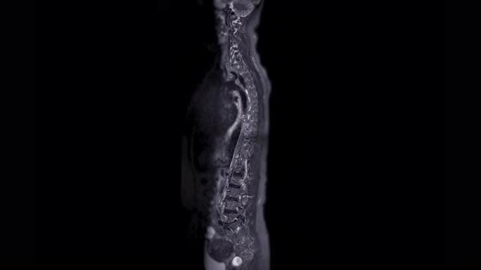 MRI筛查整个脊柱。