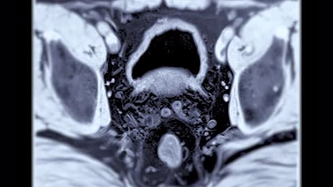 老年男性前列腺MRI诊断前列腺癌细胞。
