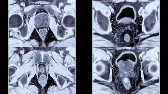 老年男性前列腺MRI诊断前列腺癌细胞。