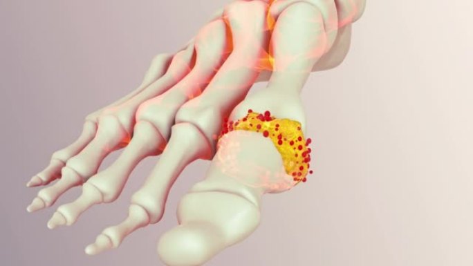 人足部痛风脚趾3D脚趾3D痛风解析3D骨
