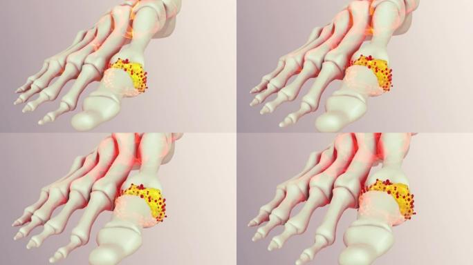 人足部痛风脚趾3D脚趾3D痛风解析3D骨