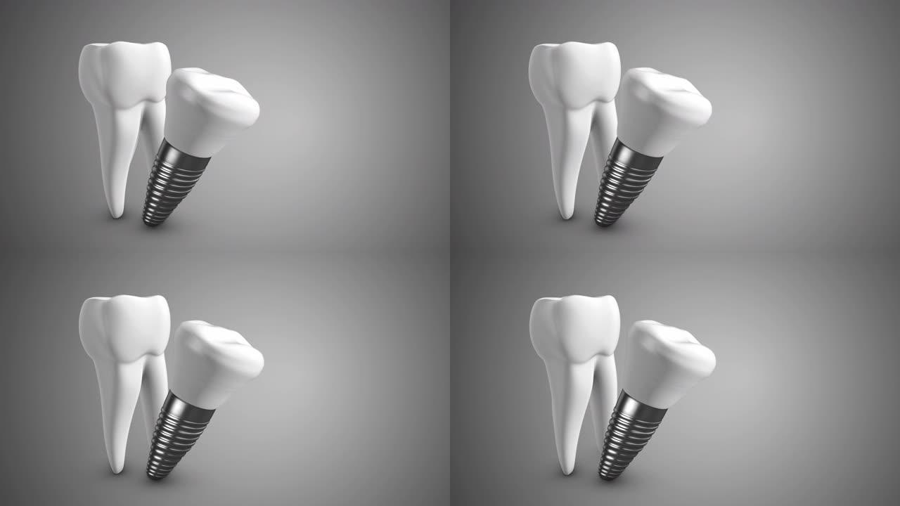 牙齿螺丝医疗技术背景