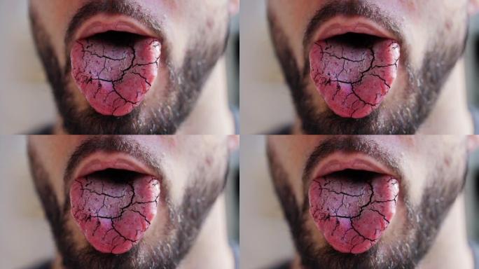 舌干疼痛和裂痕