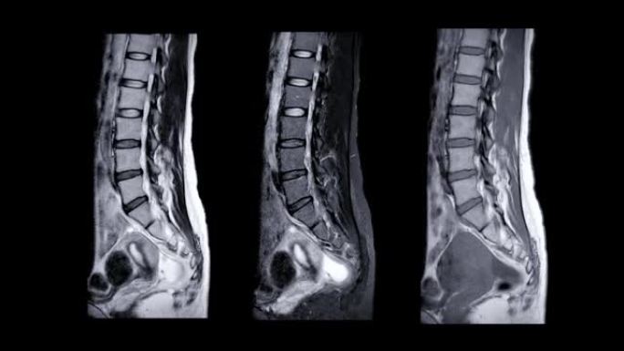 MRI l-s脊柱