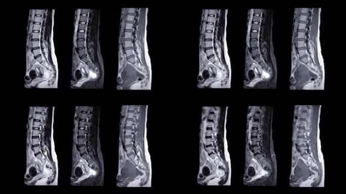 MRI l-s脊柱