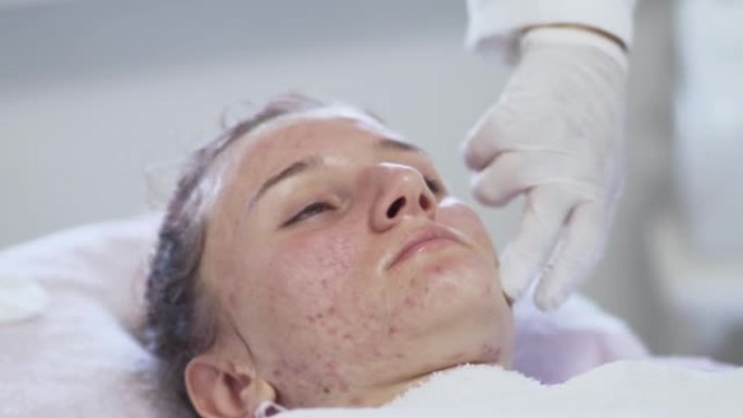 在专业美容师的办公室进行痤疮治疗。接受痤疮治疗的油性痤疮皮肤年轻女子的脸部特写