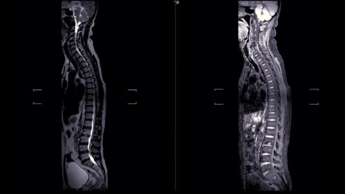 MRI筛查整个脊柱。