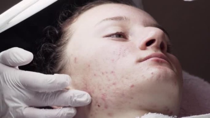 皮肤科医生检查一名患有痤疮问题的年轻女性的皮肤。脸上的疤痕和伤口。