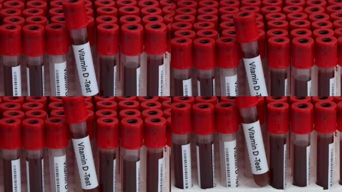实验室检测维生素d的血液样本