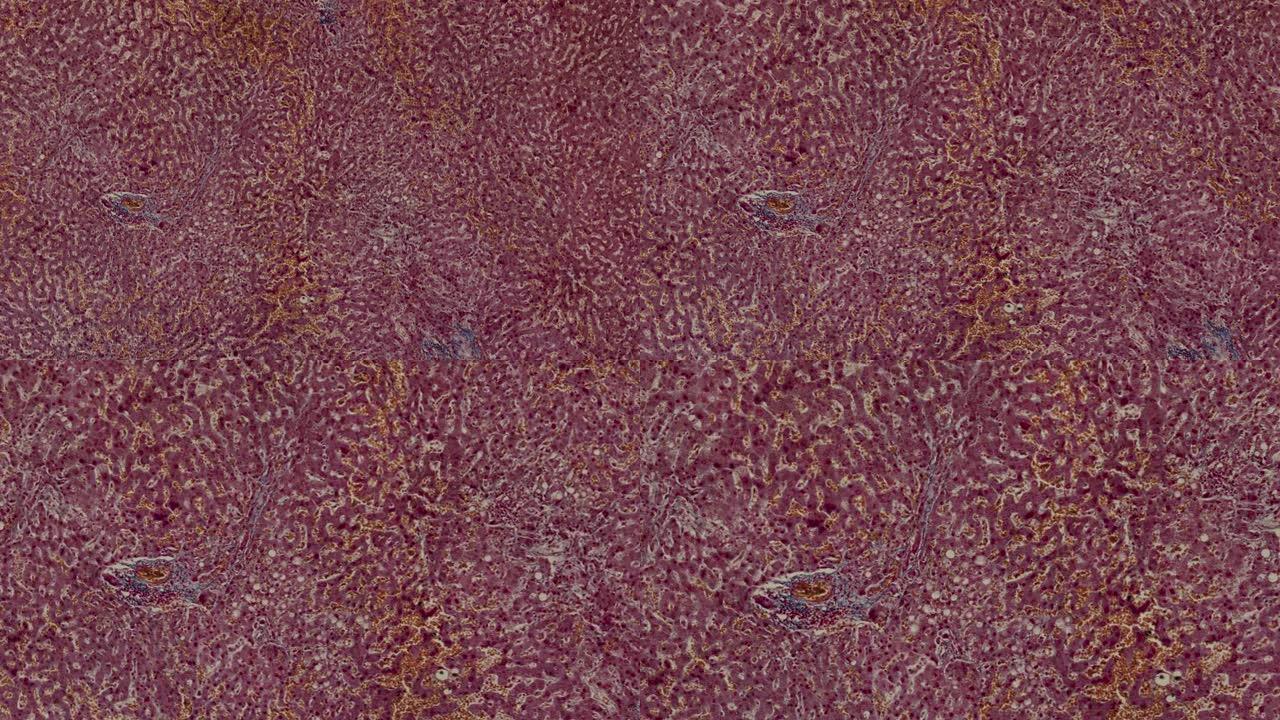 在显微镜下撞击和肿胀的人肝细胞的宏观拍摄