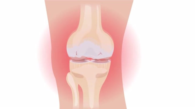 膝骨关节炎