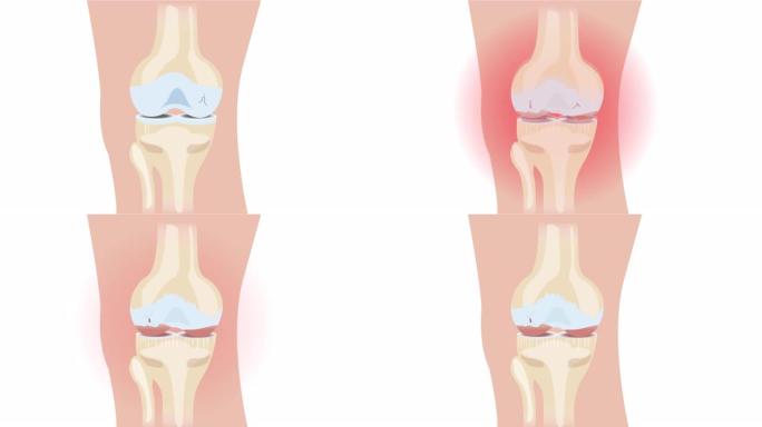 膝骨关节炎