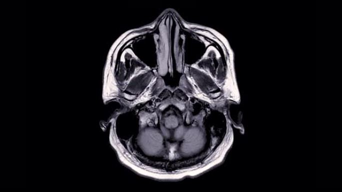 脑部核磁共振成像。
