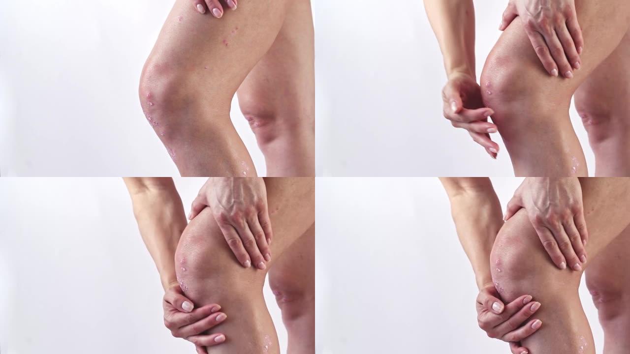 银屑病关节炎，女性膝盖上有皮肤牛皮癣。炎症性关节炎引起肿胀、僵硬、发红、疼痛和关节损伤。滑液，左膝银
