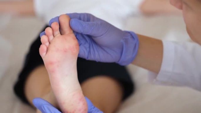 皮肤科医生检查儿童脚上的红疹近距离4k电影
