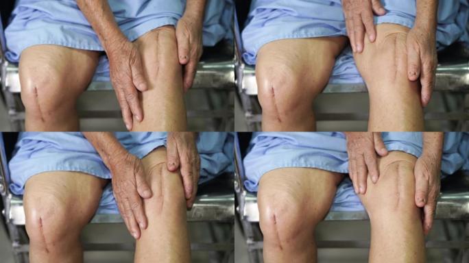亚洲老年或老年老太太患者在护理医院病房显示她的疤痕手术全膝关节置换缝合伤口手术关节置换术，健康医学观
