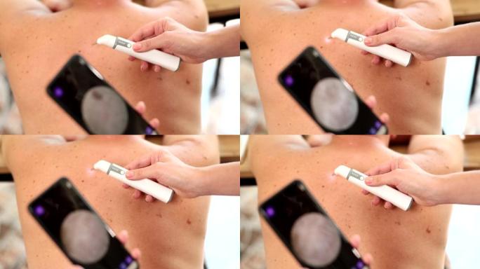 皮肤科医生用数字皮肤镜和智能手机屏幕检查患者皮肤