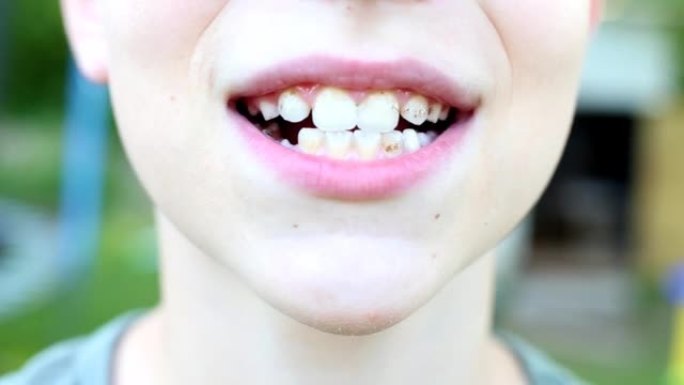 张开牙齿上有牙菌斑或牙结石的男孩的嘴。口腔卫生概念。