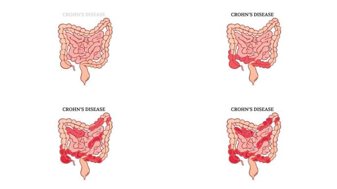 克罗恩病视频肠医学解剖动画
