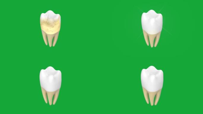 口腔卫生: 牙齿清洁超声波洗牙。人体牙齿治疗的医学精确3D动画。孤立的3d视频色度键