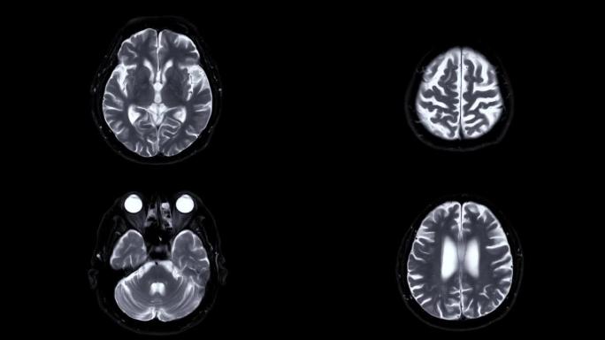 脑部核磁共振成像。