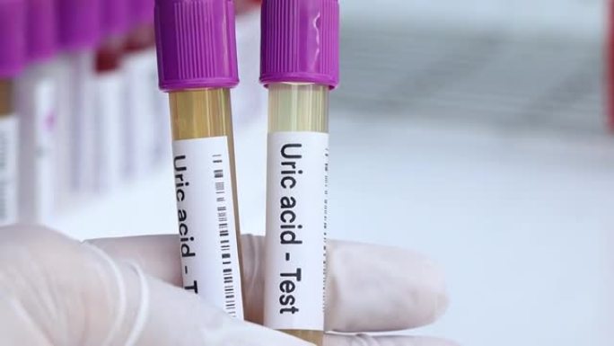 尿酸测试从尿液中寻找异常，在实验室中分析尿液样本