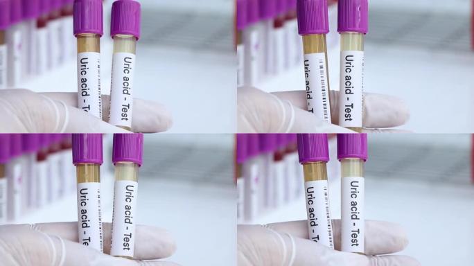 尿酸测试从尿液中寻找异常，在实验室中分析尿液样本