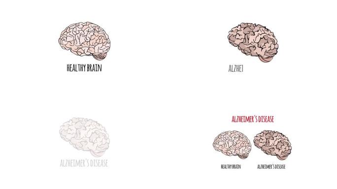 阿尔茨海默病视频记忆丧失医学教育动画剪辑